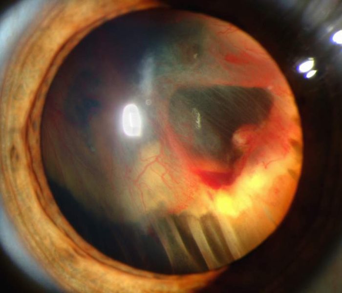 agujero macular: las causas