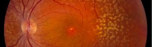 Se considera Atrofia Geográfica (GA) la forma avanzada de la degeneración macular asociada con la edad (DMAE) en su forma seca