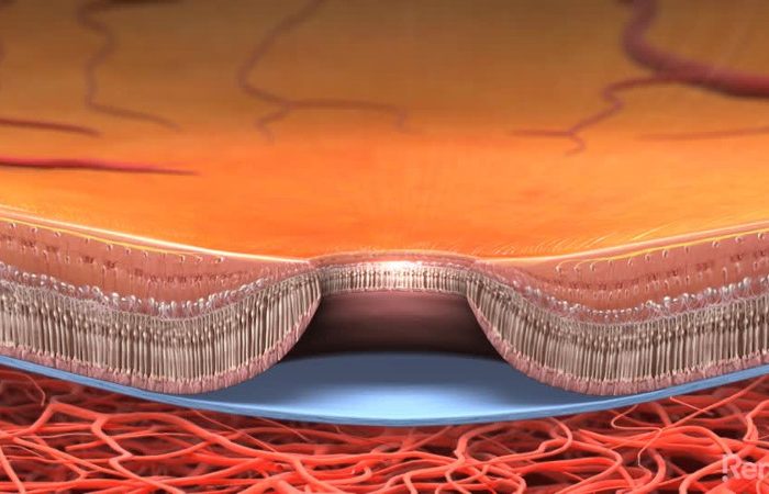 agujero macular