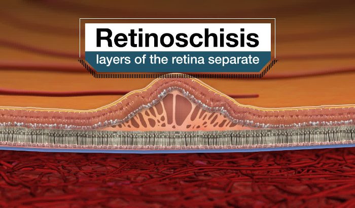 Retinosquisis significa la división de la retina del ojo en dos capas. Hay dos formas de este trastorno. La más común es una forma adquirida que afecta tanto a hombres como a mujeres.