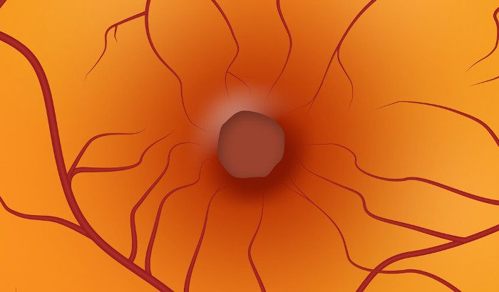 Trasplante de retina autólogo para agujero macular
