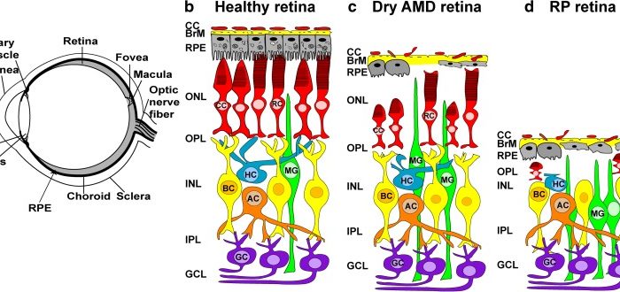 Ensayo clínico para trasplante de EPR en atrofia geográfica asociada con DMAE