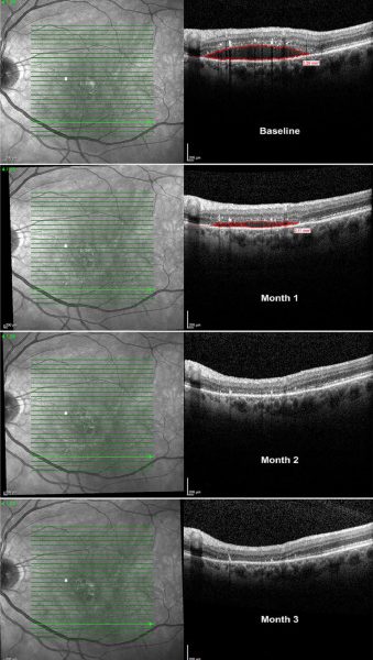 Un medicamento para Parkinson puede mejorar la visión en pacientes con DMAE