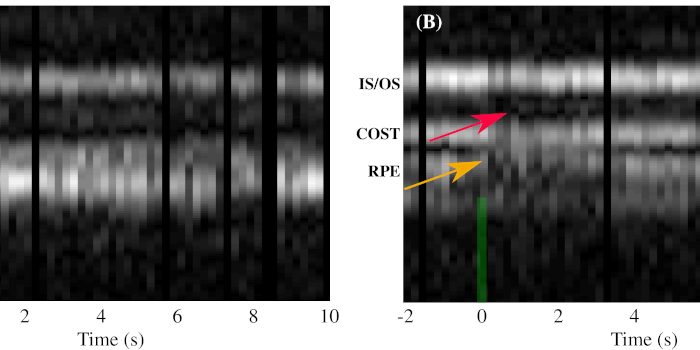 Optoretinograma: medición óptica de las respuestas de los fotorreceptores humanos a la luz