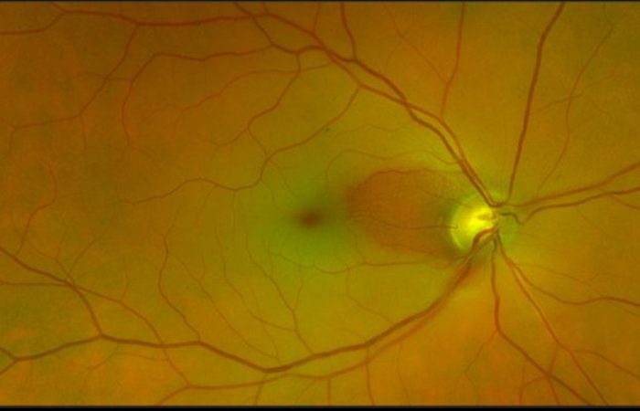 Obstrucción de la arteria central de la retina