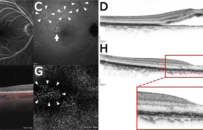 Membranas neovasculares (MNV), coriorretinopatía serosa central, vasculopatía coroidea polipoidea y genómica